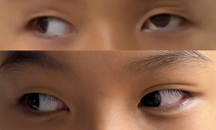 男童眼眶骨折眼球無法內轉　鏡湖鼻內鏡微創手術助無痕修復